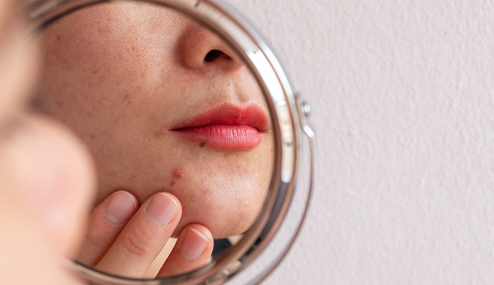 Acne in Teenagers and Menopause: Strategies for Estheticians