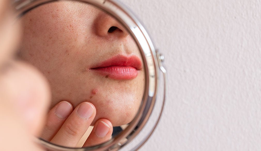 Acne in Teenagers and Menopause: Strategies for Estheticians - LaFlore