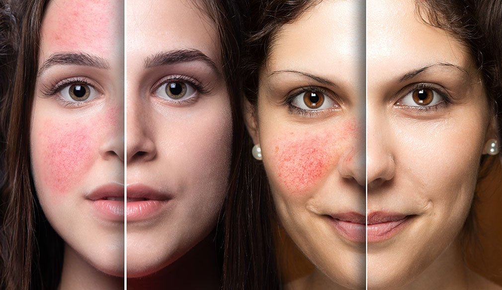 Effective Dermatitis Relief Through Topical Probiotics: A Comprehensive Guide - LaFlore