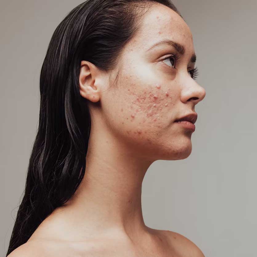 Skin Inc: Managing Acne Through the Microbiome