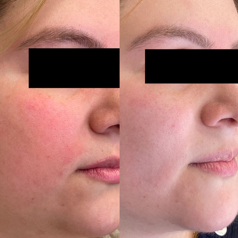 Rosacea Relief Set - LaFlore