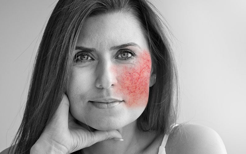 rosacea relief - probiotic skincare