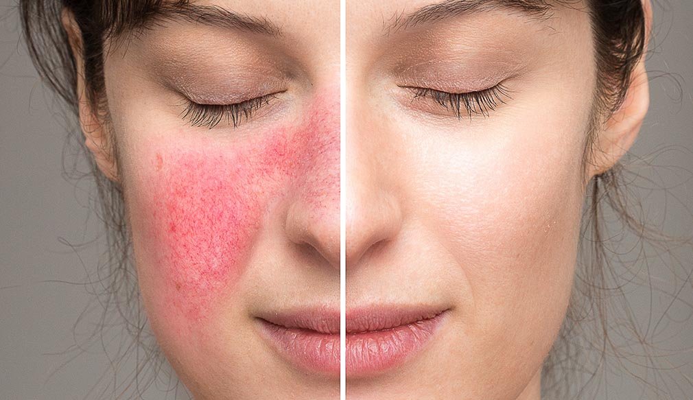 Rosacea Symptoms And Treatment With Topical Live Probiotics - LaFlore