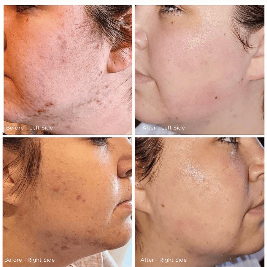Stress Got Your Skin Freaking Out? The Surprising Link to Breakouts - LaFlore