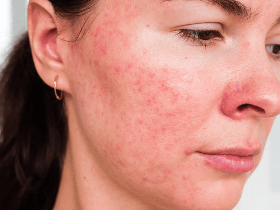 Your Skin's Best Defense Against Irritation & Infection? A Healthy Microbiome! - LaFlore